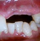 讲述:胡先生因全口牙缺失在侯录口腔医院做种植牙整形案例