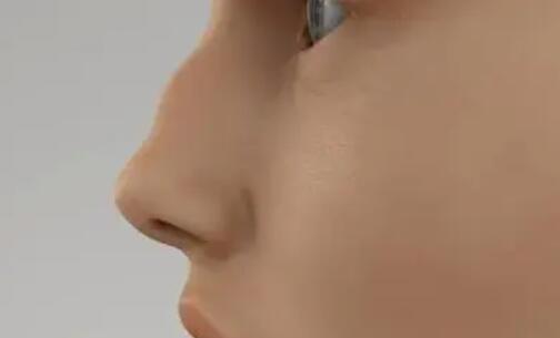驼峰鼻鼻部整形效果怎么样？恢复期是多久？来看详细介绍！