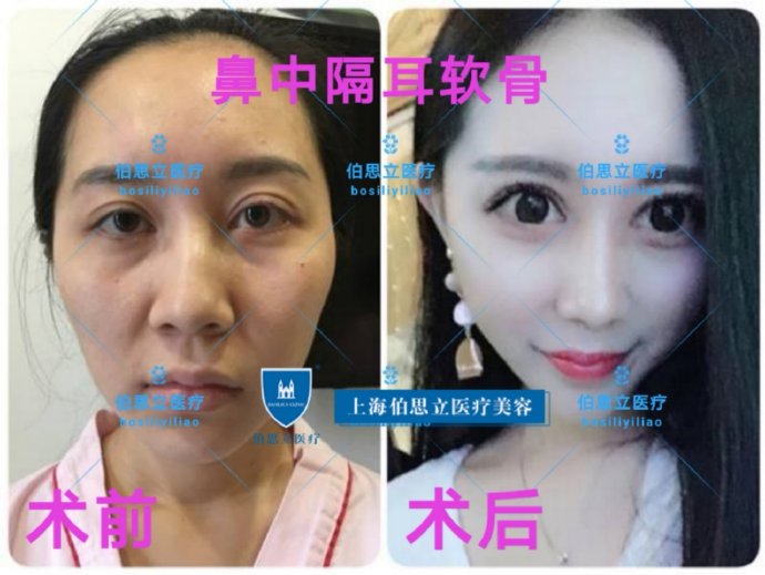 上海最有名气的鼻王是哪位医生？