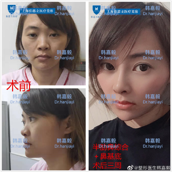 上海最有名气的鼻王是哪位医生？