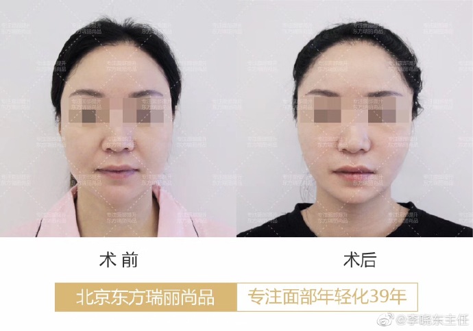 北京杨大平和李晓东谁的面部提升更好？