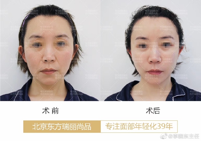 北京杨大平和李晓东谁的面部提升更好？