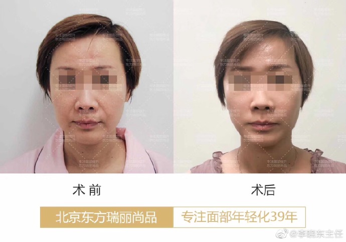 北京杨大平和李晓东谁的面部提升更好？