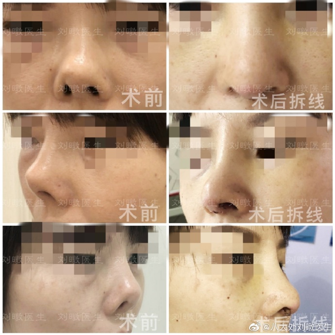 中国很难预约十大隆鼻专家