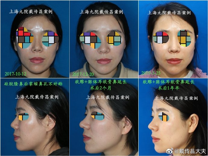 中国很难预约十大隆鼻专家