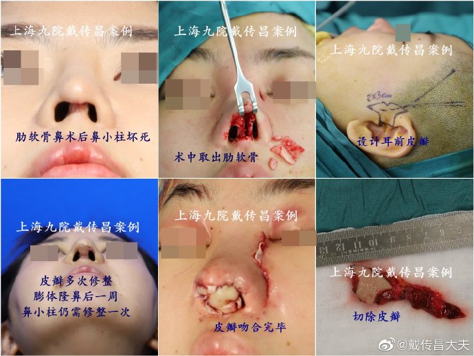 中国很难预约十大隆鼻专家