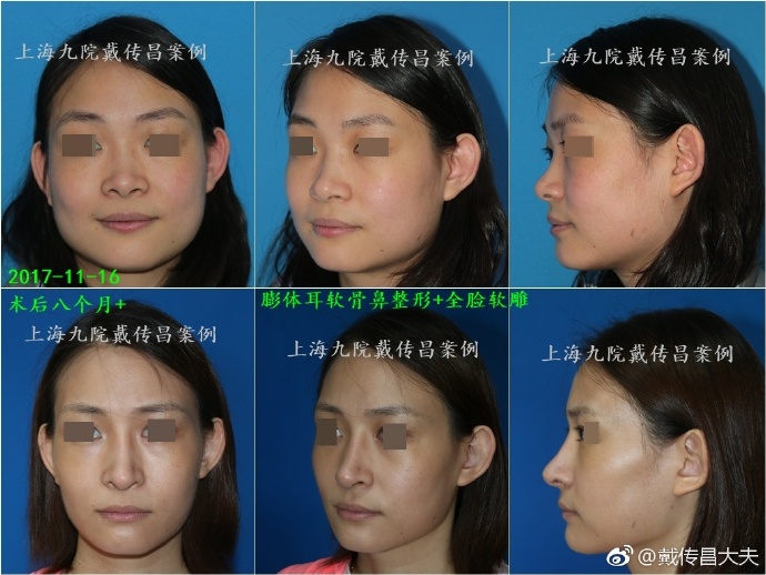 中国很难预约十大隆鼻专家