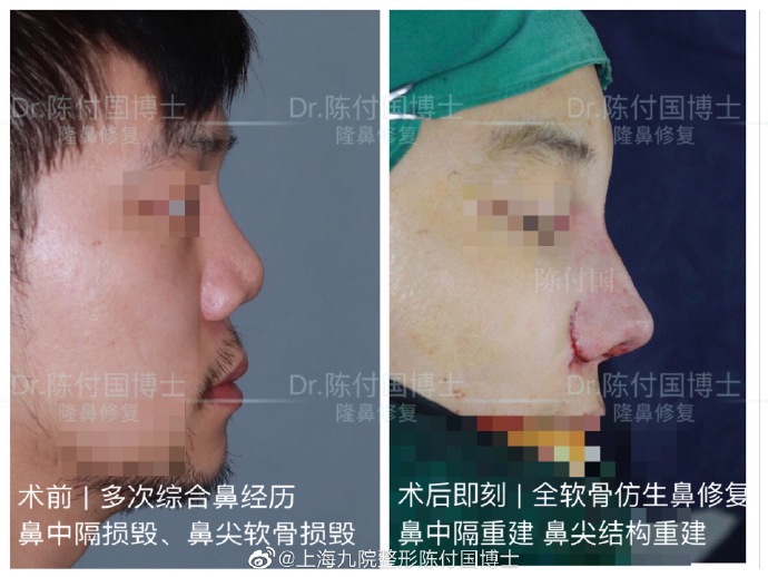 中国很难预约十大隆鼻专家