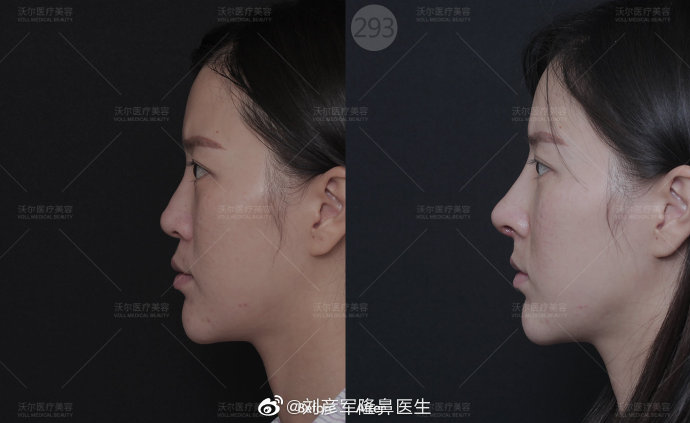 中国很难预约十大隆鼻专家