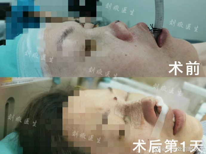 刘暾鼻修复案例