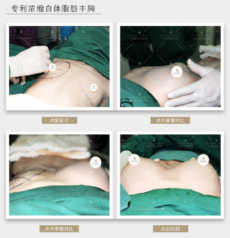 北京脂肪丰胸韦元强和任学会哪个好？