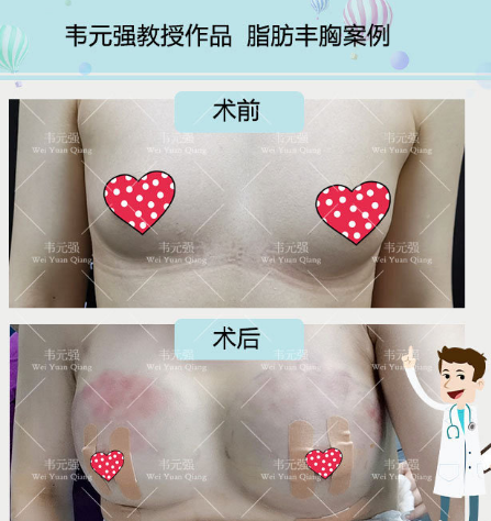 北京脂肪丰胸韦元强和任学会哪个好？