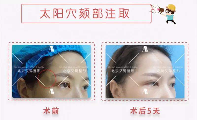 丁小邦奥美定取出案例