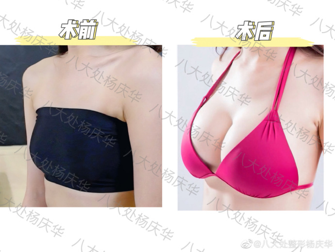 杨庆华_京协和医学院整形外科隆胸吸脂专家
