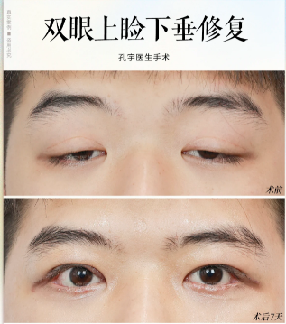 孔宇上睑下垂矫正修复