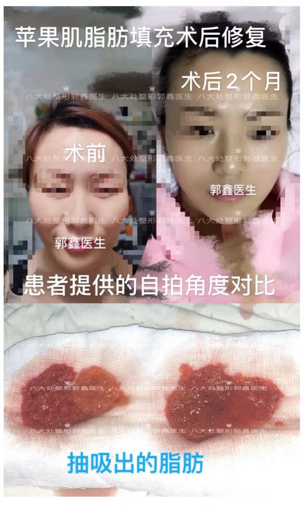郭鑫面部修复案例