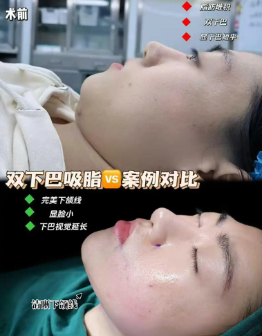 吸脂案例
