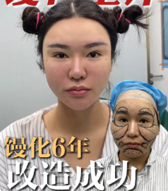 金洪尧馒化修复