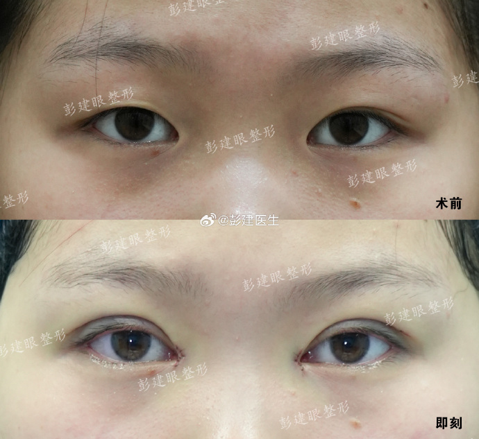 无锡彭建做双眼皮修复技术怎么样？好不好？彭建眼修复咨询预约电话