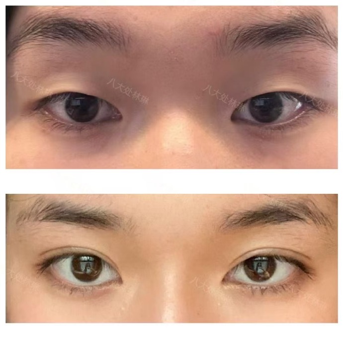 林琳双眼皮案例