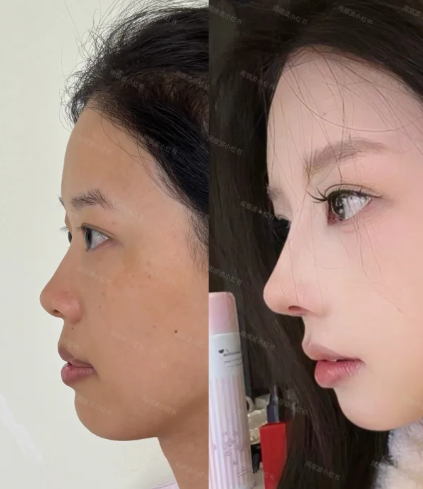 成都周顺波和李竞鼻修复哪个好?