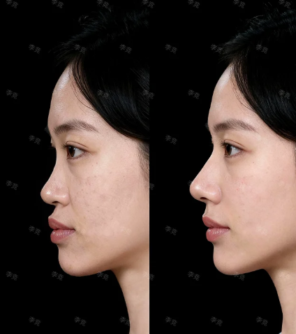 李竞鼻修复案例