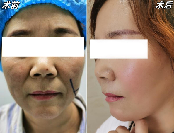 温志华拉皮案例