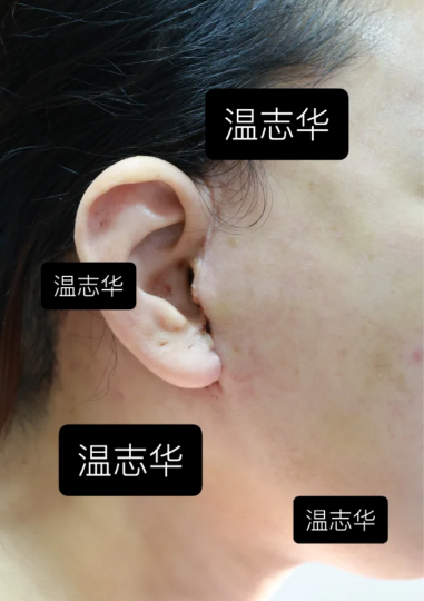 温志华拉皮术后疤痕