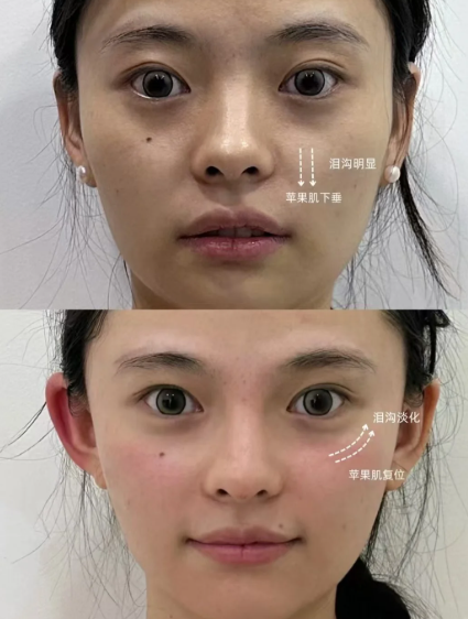 成都张艳锋苹果肌复位技术怎么样?效果好吗?收费贵不贵?