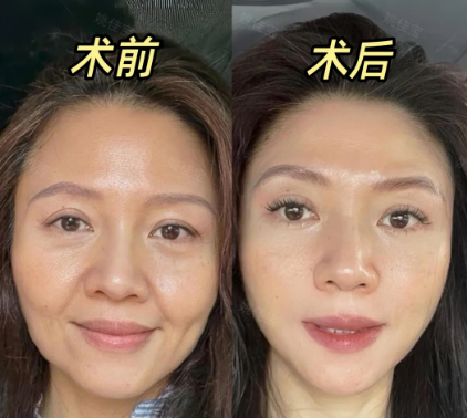 成都姚佳宝做眼周抗衰技术怎么样?