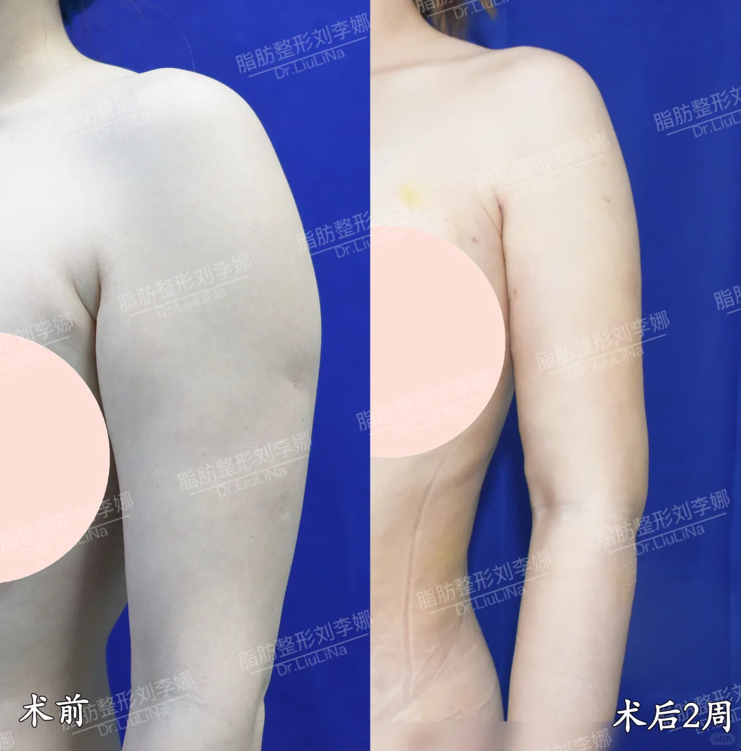 上海刘李娜吸脂技术怎么样?体雕效果好不好?