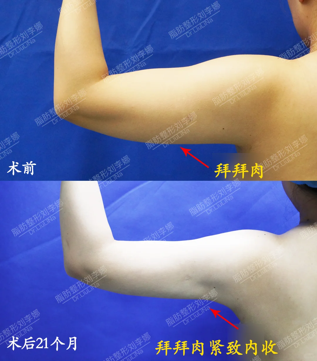 刘李娜手臂吸脂