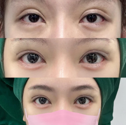 杨荣华双眼皮案例