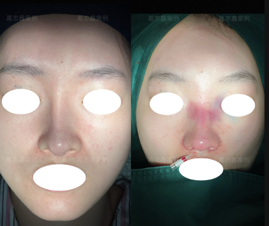 葛志鑫鼻修复案例