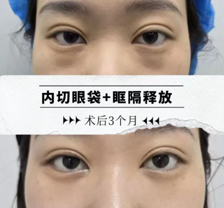 于燕祛眼袋案例