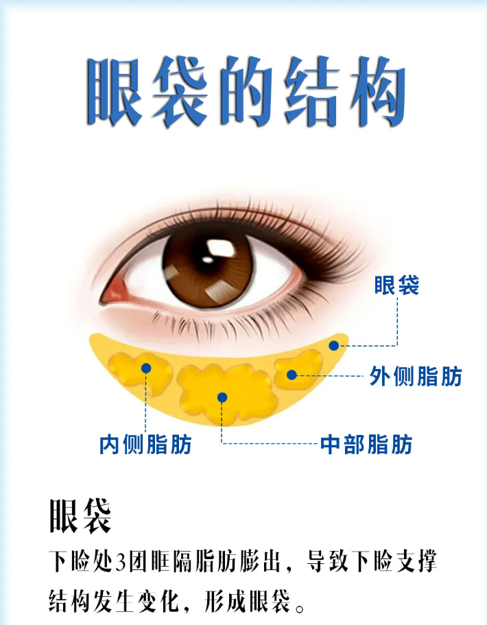 杭州翁胜涛祛眼袋技术怎么样?效果好不好?