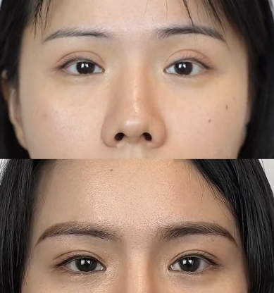 高亮双眼皮修复