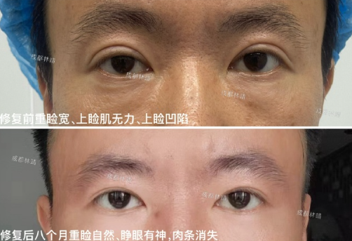 林靖双眼皮案例