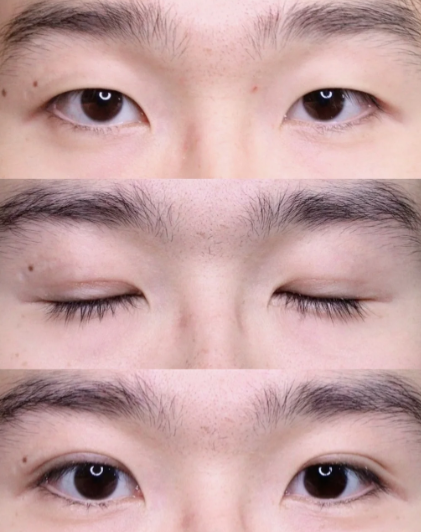 练才华双眼皮案例