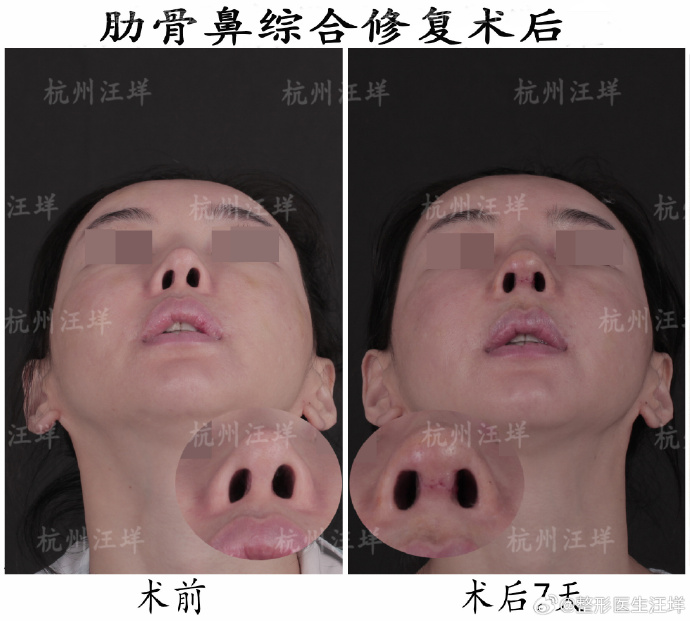 汪垟鼻修复案例