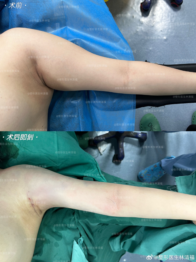 林清福吸脂案例