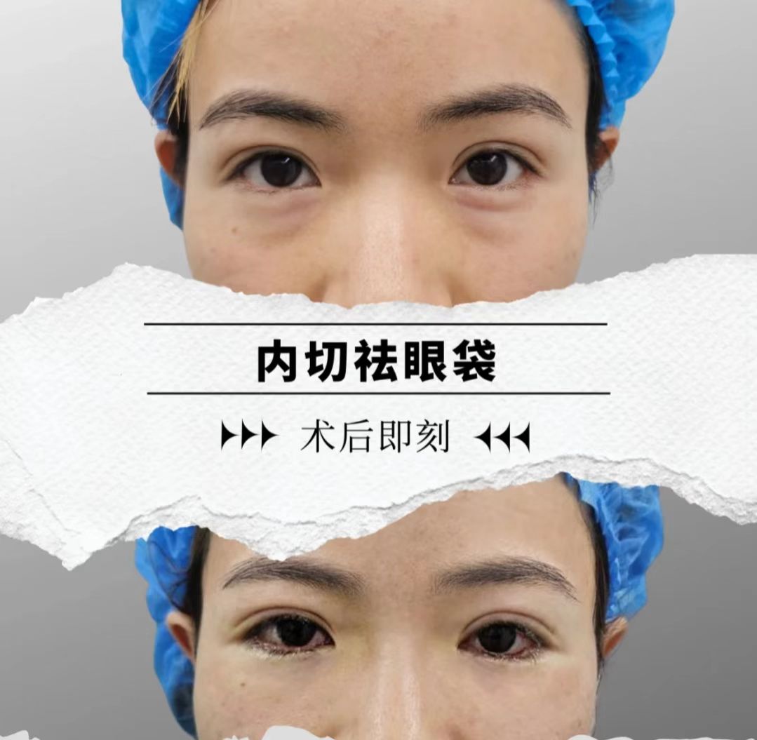 于燕祛眼袋案例