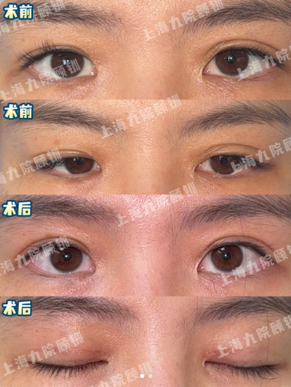 双眼皮修复案例