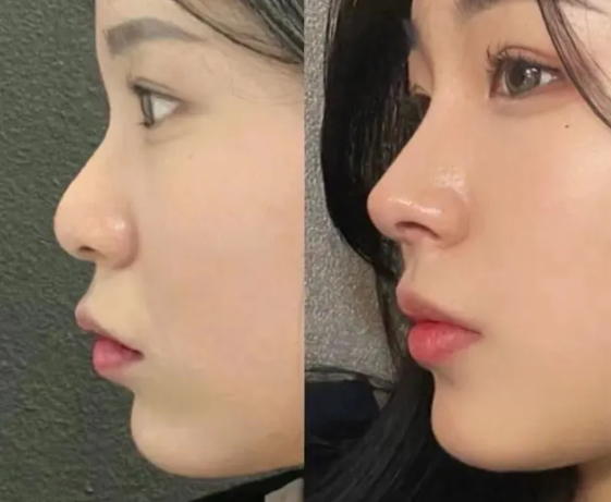 徐航鼻修复案例