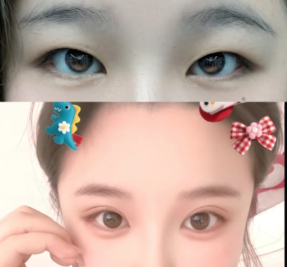 张娜双眼皮案例