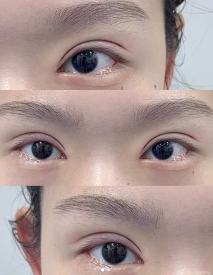 滕双艳双眼皮案例