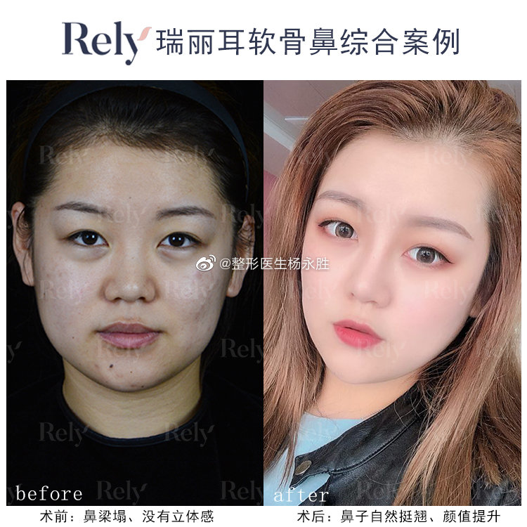 杨永胜鼻子案例