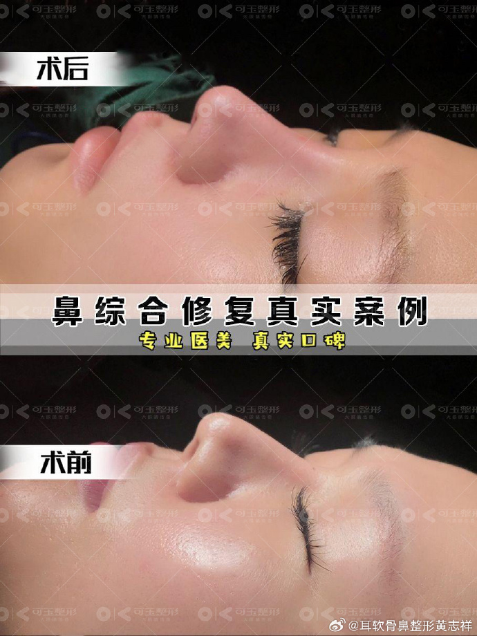 黄志祥隆鼻案例