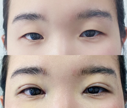 李研双眼皮案例