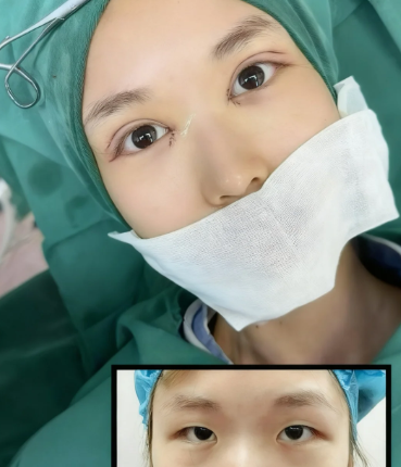 杨熙双眼皮案例